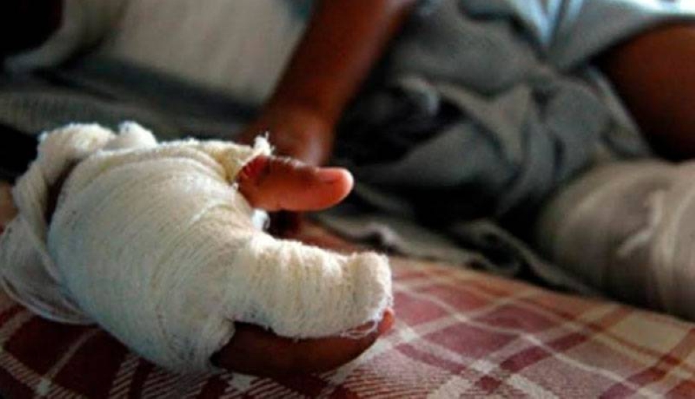 Hubo 184 quemados en fiestas de fin de año