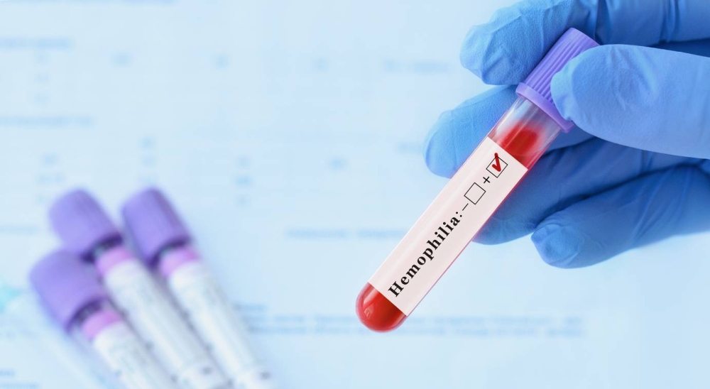 Hemofilia y fibrosis quística, las enfermedades raras más frecuentes en El Salvador