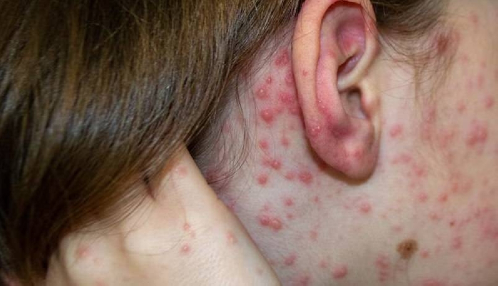 Infectólogo llama a padres de familia a completar vacunación de sus hijos contra el sarampión