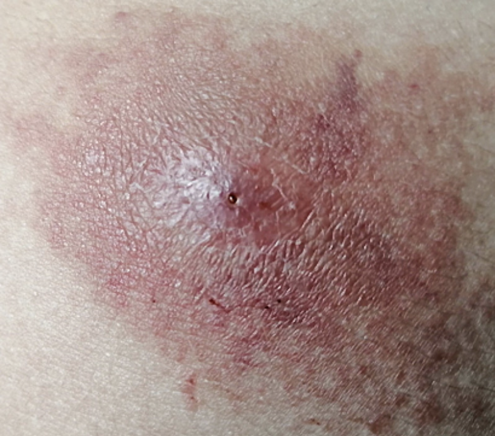 Salud confirma los primeros tres casos de gusano barrenador en humanos en El Salvador