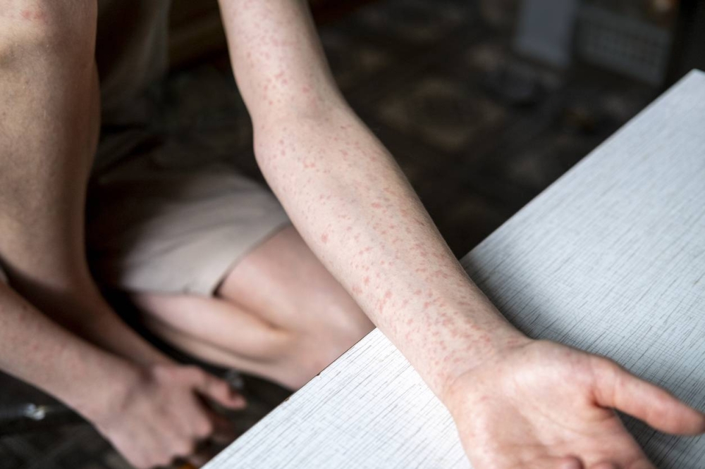 Honduras declara alerta sanitaria por sarampión y exigirá vacunación para ingresar al país