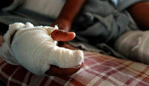 Quemados por incendios con leve repunte y totalizan 13 casos en el primer semestre