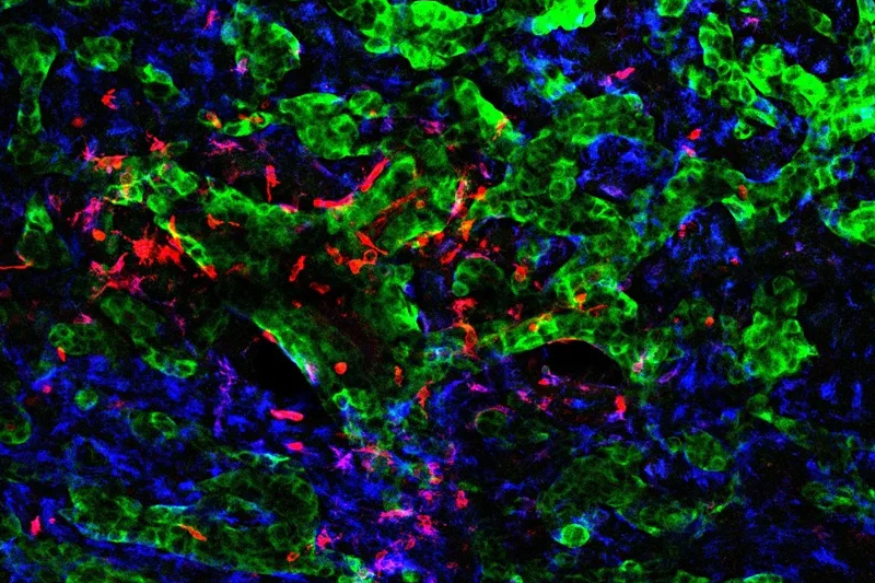 Investigadores españoles descubren cómo las células tumorales alteran el cerebro y logran diseminar el cáncer